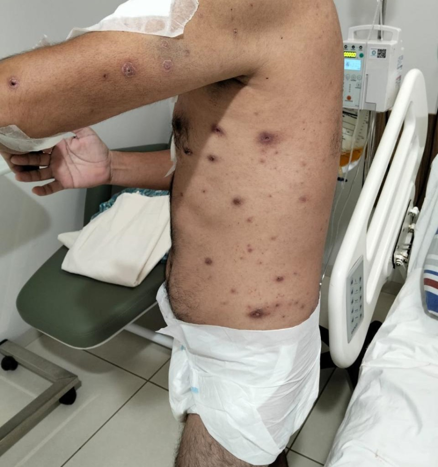 Saúde em Matupá: Denúncias de infecções graves no Hospital Municipal mobilizam vereador e cobram ação do Estado